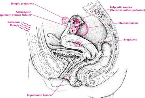 treatmrnt for menstrual disorders in homeopathy